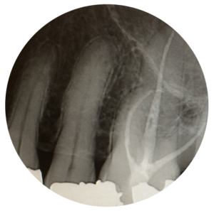 Tooth x-ray Ellerslie 66 Dental.