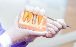 Dental Implant Model.