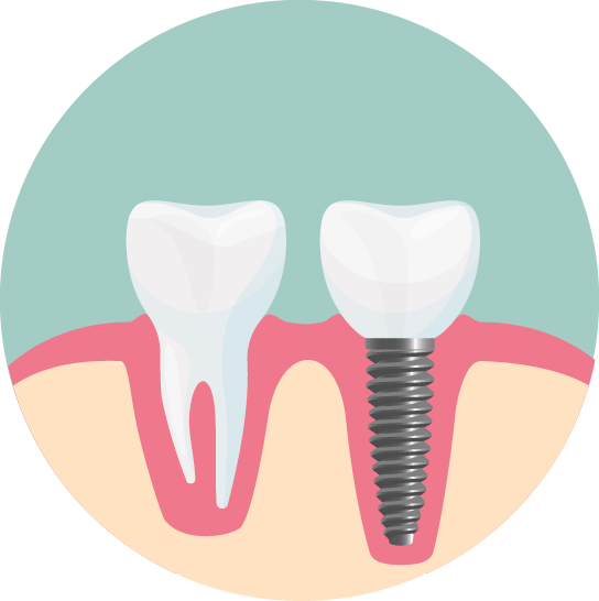 Illustration of dental implant