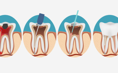 A Comprehensive Guide to Understanding Root Canals