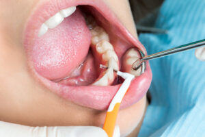 Up close image of teeth being cleaned at the dentist.