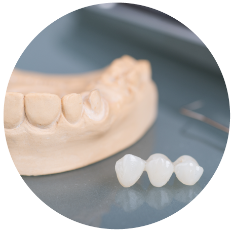 Dental bridge next to a tooth model.