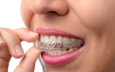 What Is Invisalign and How Does It Work?