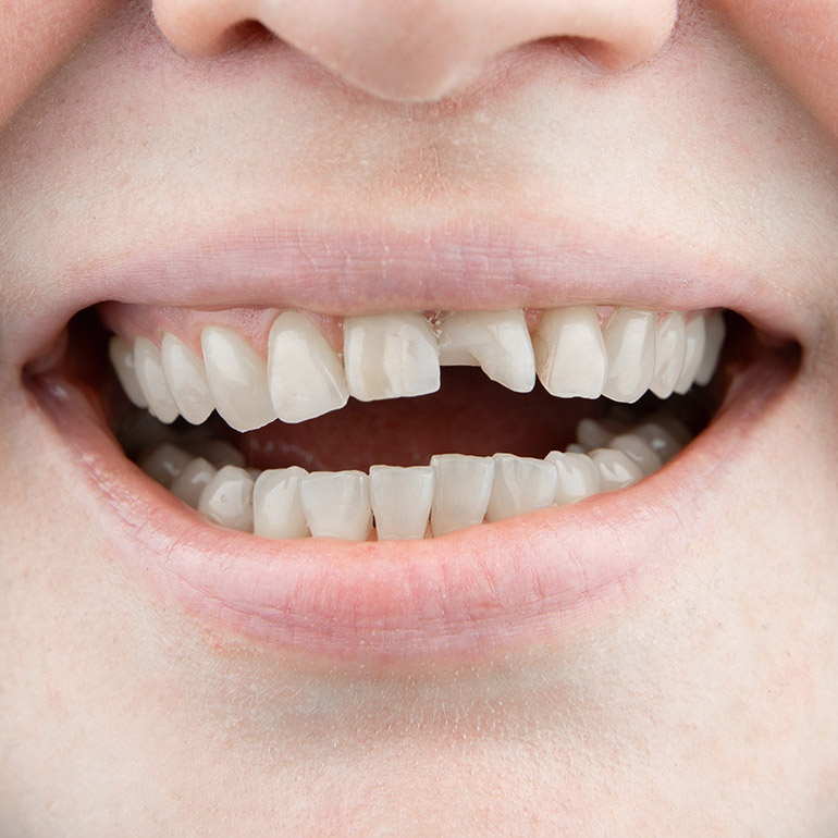 Close up of a person smiling with an obvious chipped tooth.